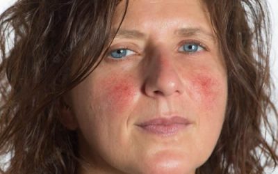 Discovering the Effectiveness of the Latest Rosacea Treatments