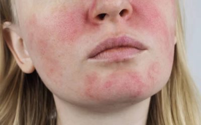 Rosacea And You